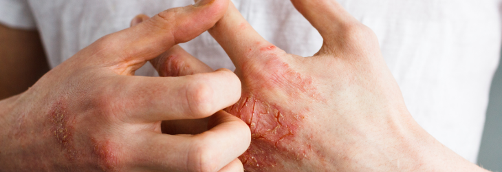 Hænder med rødt, tørt og revnet udslæt, typisk for kontakteksem, mens personen klør på huden