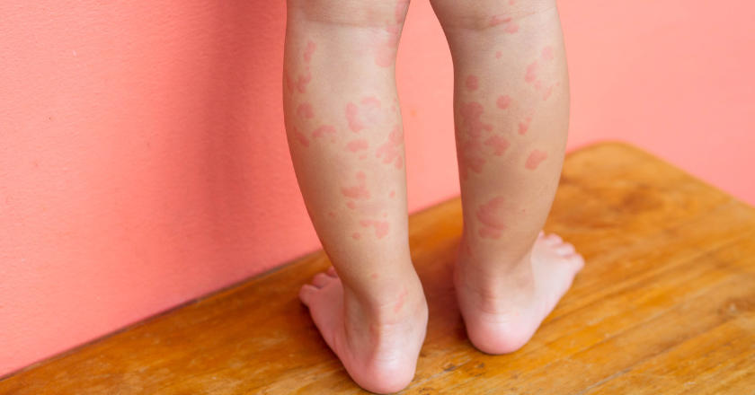 nældefeber urticaria barn børn